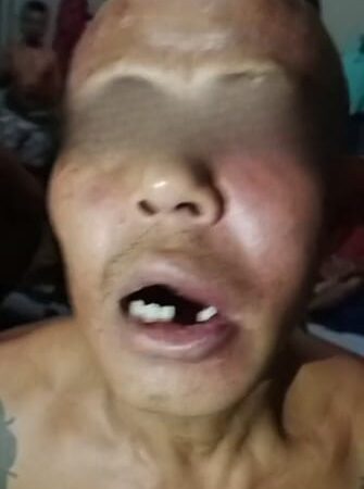 (Diduga) Oknum Petugas Pukul Warga Binaan Rutan Kelas II B Bengkayang